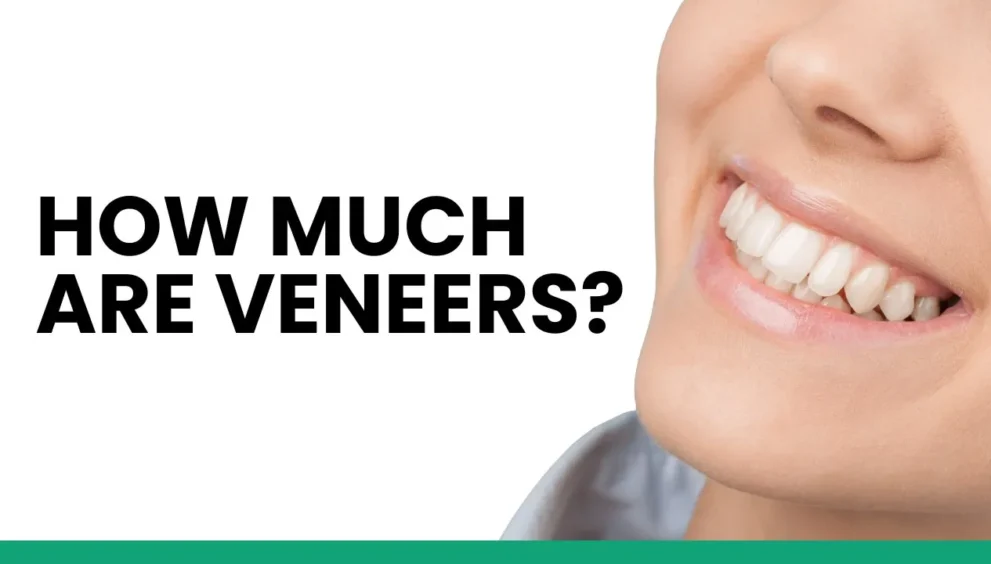 how much are veneers